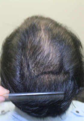 hair transplant photos