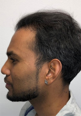 hair transplant photos