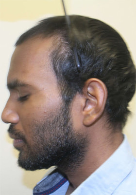 hair transplant photos