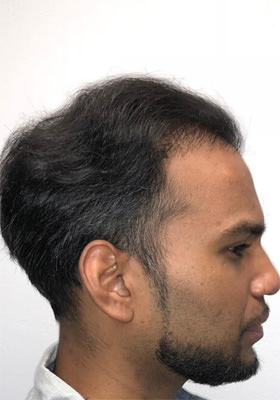 hair transplant photos