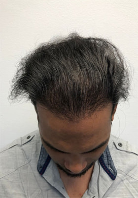 hair transplant before after Photos