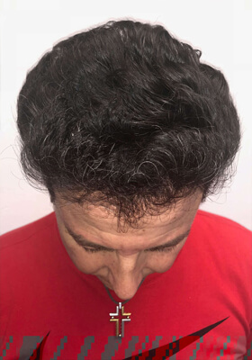 hair transplant before after Photos