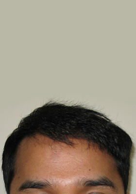 hair transplant before after Photos