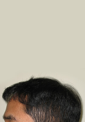 hair transplant photos