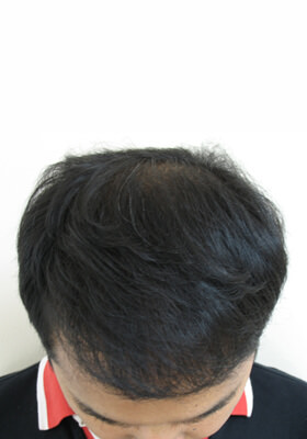 hair transplant photos