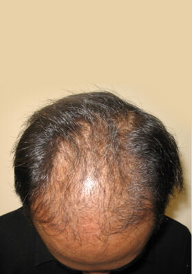 hair transplant before after Photos