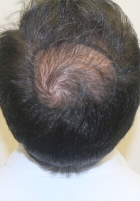 hair transplant before after Photos