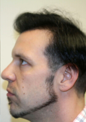 hair transplant before after Photos