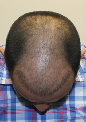 hair transplant before after Photos