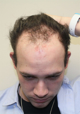 hair transplant before after Photos