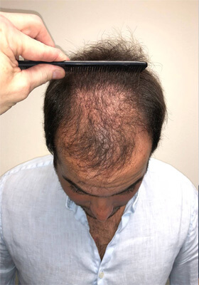 hair transplant before after Photos