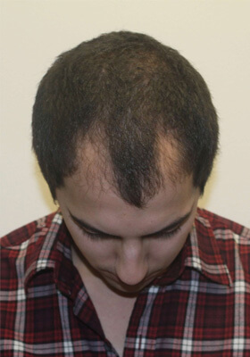 hair transplant before after Photos