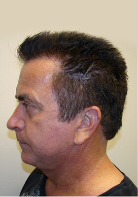 hair transplant photos