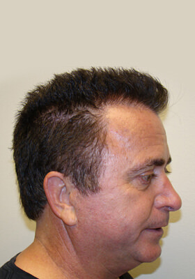 hair transplant before after Photos