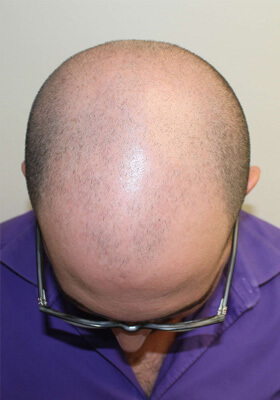 hair transplant before after Photos