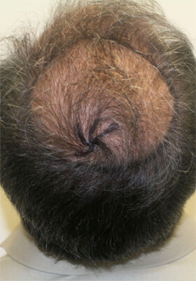 hair transplant before after Photos