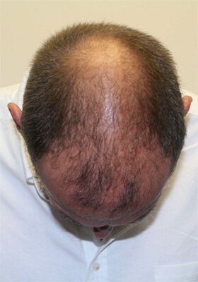 hair transplant before after Photos