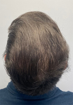 hair transplant photos