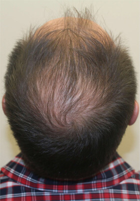 hair transplant photos