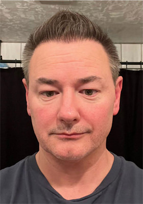 hair transplant before after Photos