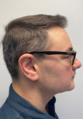 hair transplant photos