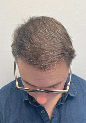 hair transplant photos