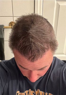 hair transplant photos