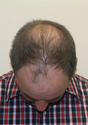 hair transplant photos