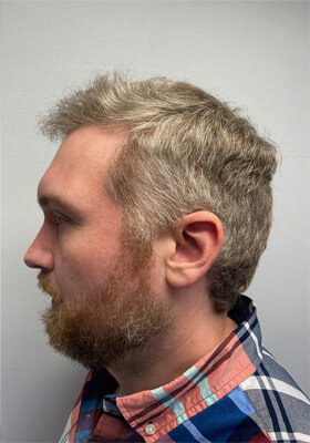 hair transplant photos