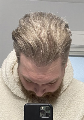 hair transplant photos