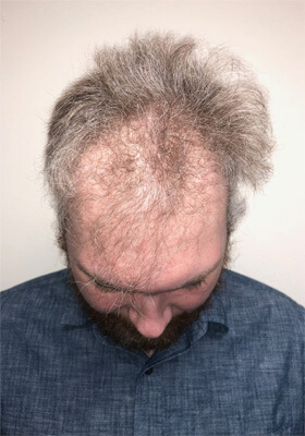 hair transplant before after Photos