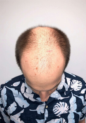 hair transplant photos