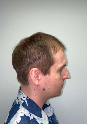 hair transplant photos