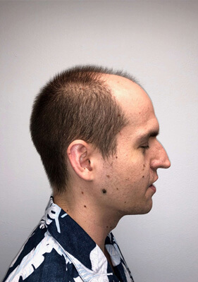 hair transplant photos