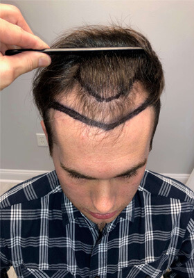 hair transplant before after Photos