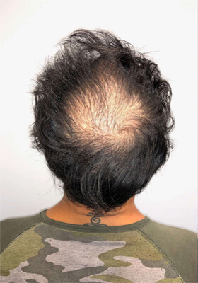 hair transplant before after Photos