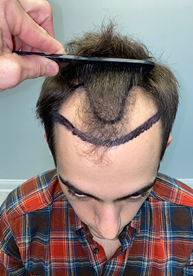 hair transplant before after Photos