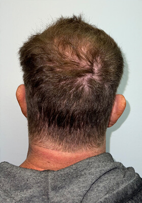 hair transplant before after Photos