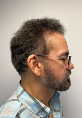 Hair Transplant Patient Photos
