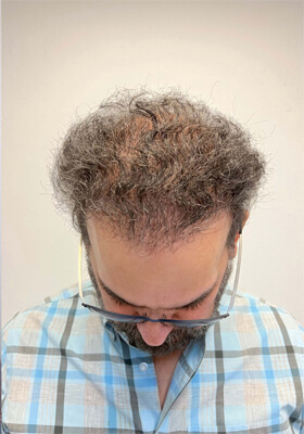 hair transplant before after Photos