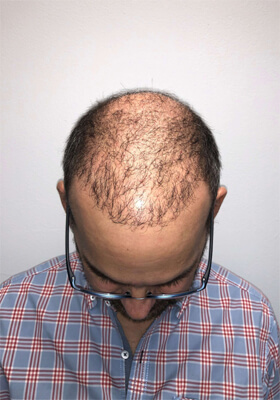 hair transplant before after Photos