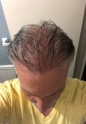 hair transplant before after Photos