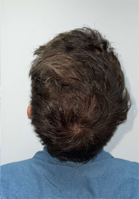 hair transplant photos