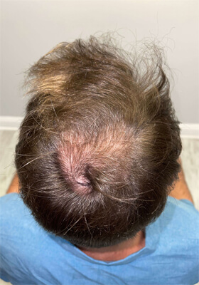 hair transplant before after Photos