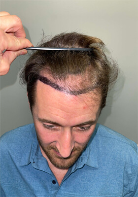 hair transplant photos