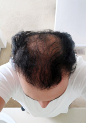 hair transplant photos