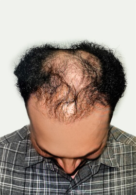 hair transplant before after Photos