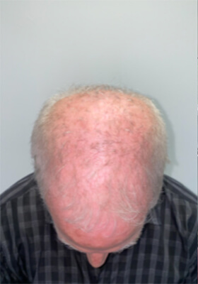 hair transplant photos