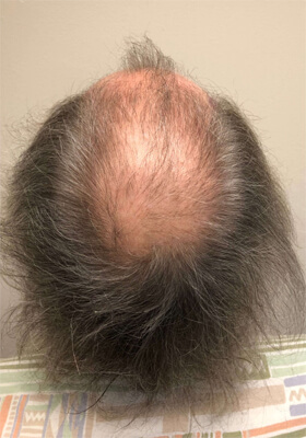 hair transplant before after Photos