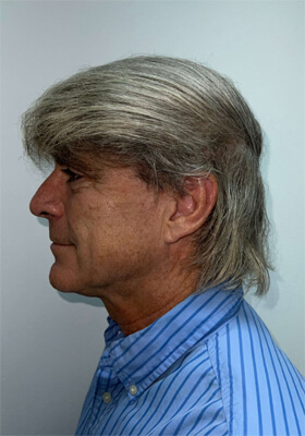 hair transplant photos